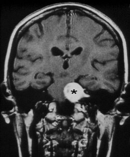 Brughoektumor | Acoustic neuroma