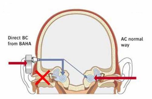 de werking van het Baha-systeem bij éénzijdig, conductief gehoorverlies