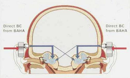 De werking van het Baha-systeem bij tweezijdig, conductief gehoorverlies
