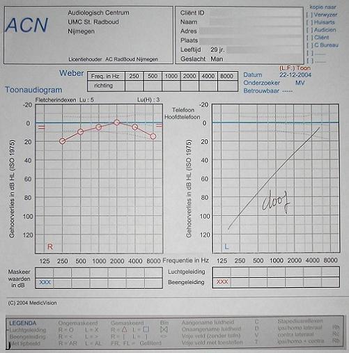 Mijn eigen toonaudiogram uit 2004 | met CTRL + is de afbeelding te vergroten