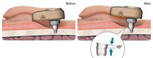 schuin abutment van Oticon Medical